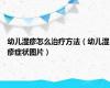 幼儿湿疹怎么治疗方法（幼儿湿疹症状图片）