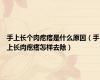 手上长个肉疙瘩是什么原因（手上长肉疙瘩怎样去除）